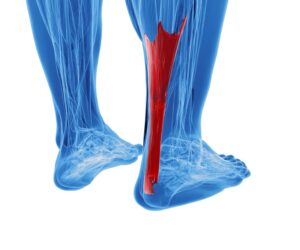 קרע בגיד אכילס